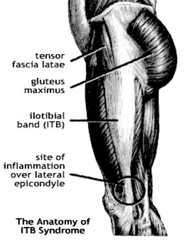 Iliotibial Band Friction Syndrome (ITBFS) - Beechboro Physiotherapy